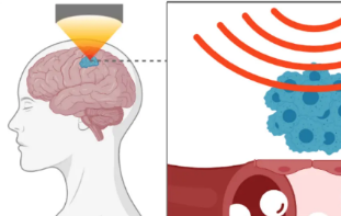 聚焦超声技术导致神经退行性疾病生物标志物的释放